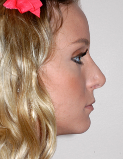 Rhinoplasty for Teens