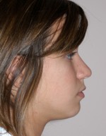 Rhinoplasty for Teens