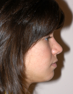 Rhinoplasty for Teens