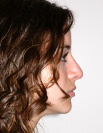 Rhinoplasty for Teens