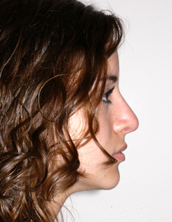 Rhinoplasty for Teens Case 2305 After Photo Rhinoplasty for Teens
