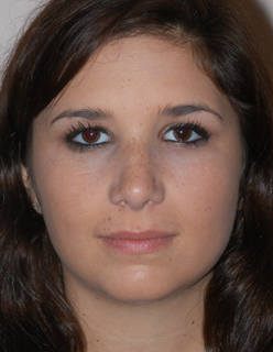 Rhinoplasty for Teens Case 2320 After Photo Rhinoplasty for Teens