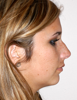 Rhinoplasty for Teens Case 2320 Before Photo Rhinoplasty for Teens