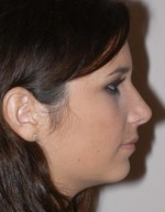 Rhinoplasty for Teens