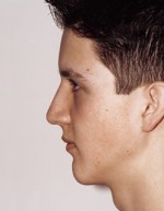 Rhinoplasty for Teens