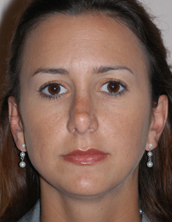 Rhinoplasty Revision Case 2135 Before Photo Rhinoplasty Revision