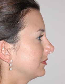 Rhinoplasty Revision Case 2135 Before Photo Rhinoplasty Revision