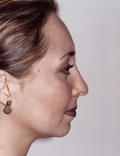 Rhinoplasty Revision