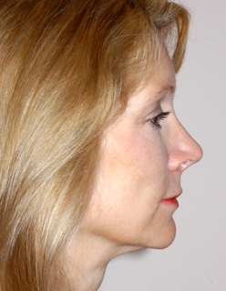 Rhinoplasty Revision