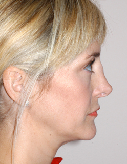 Rhinoplasty Revision Case 2221 Before Photo Rhinoplasty Revision