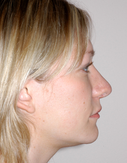Rhinoplasty Revision Case 2240 Before Photo Rhinoplasty Revision