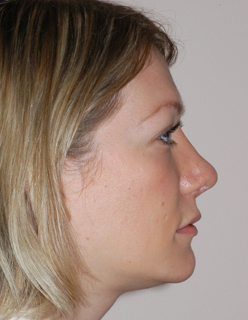 Rhinoplasty Revision