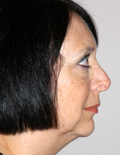 Rhinoplasty Revision Case 2259 Before Photo Rhinoplasty Revision