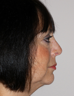 Rhinoplasty Revision