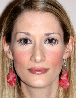 Rhinoplasty Revision Case 2277 Before Photo Rhinoplasty Revision