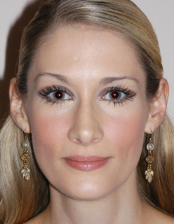Rhinoplasty Revision Case 2277 After Photo Rhinoplasty Revision