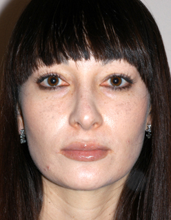 Rhinoplasty Revision