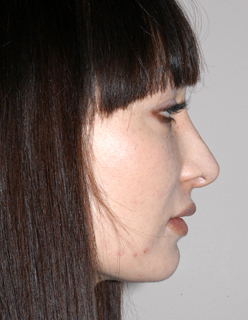 Rhinoplasty Revision