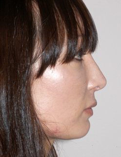 Rhinoplasty Revision