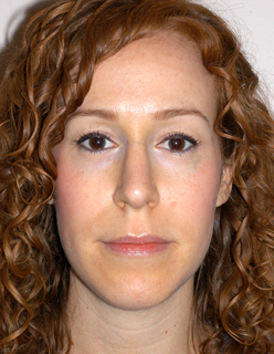 Rhinoplasty Revision Case 2313 After Photo Rhinoplasty Revision
