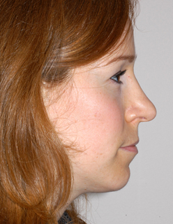 Rhinoplasty Revision Case 2313 Before Photo Rhinoplasty Revision