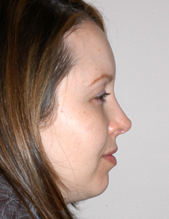 Rhinoplasty Revision