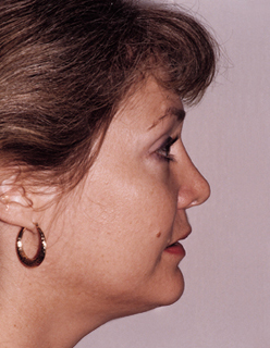 Rhinoplasty Revision