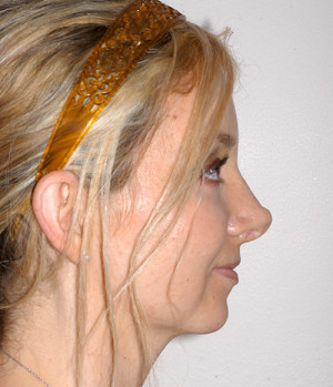 Rhinoplasty Revision Case 2760 Before Photo Rhinoplasty Revision