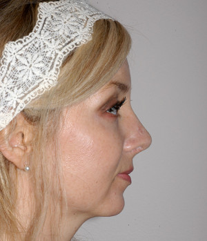 Rhinoplasty Revision Case 2760 After Photo Rhinoplasty Revision