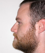 Rhinoplasty for Men