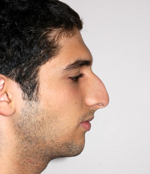 Rhinoplasty for Men