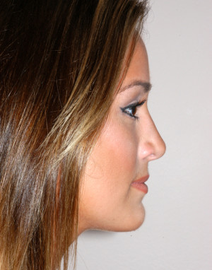 Rhinoplasty for Teens