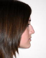 Rhinoplasty for Teens