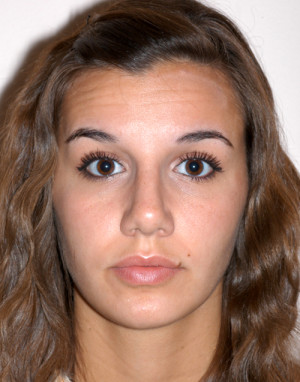 Rhinoplasty for Teens