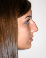 Rhinoplasty for Teens