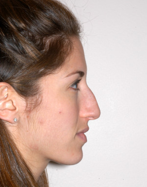 Rhinoplasty for Women