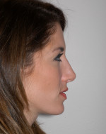 Rhinoplasty for Women