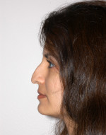 Rhinoplasty for Women