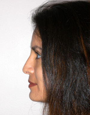 Rhinoplasty for Women