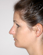 Rhinoplasty for Women