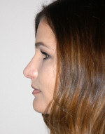 Rhinoplasty for Women