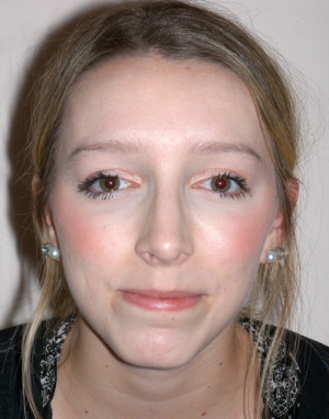 Rhinoplasty for Teens