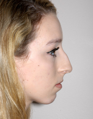 Rhinoplasty for Teens