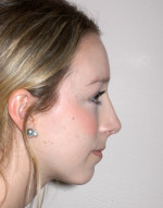 Rhinoplasty for Teens