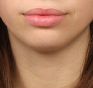 Cheek and Chin Augmentation