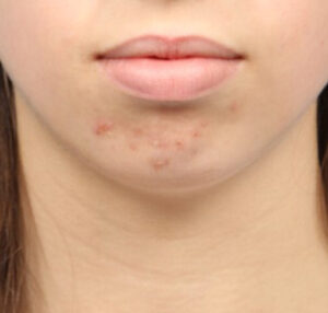 Cheek and Chin Augmentation