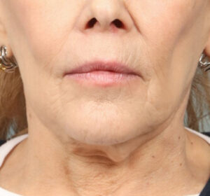 Face and Neck Lift