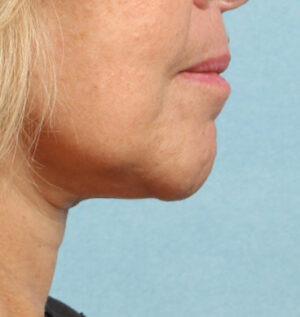 Face and Neck Lift Case 11806 After Photo Face and Neck Lift