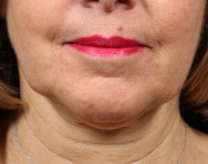 Face and Neck Lift Case 11806 Before Photo Face and Neck Lift