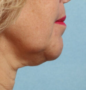 Face and Neck Lift Case 11806 Before Photo Face and Neck Lift